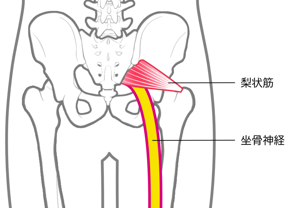 梨状筋症候群