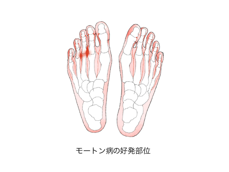 モートン病の好発部位を表した図